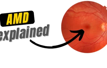 Macular Degeneration: Causes & Treatment