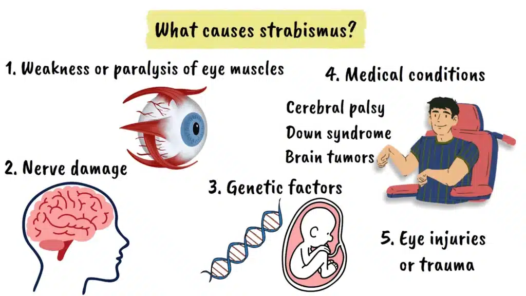 Strabismus causes
