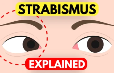 Strabismus: Causes, Symptoms & Treatment