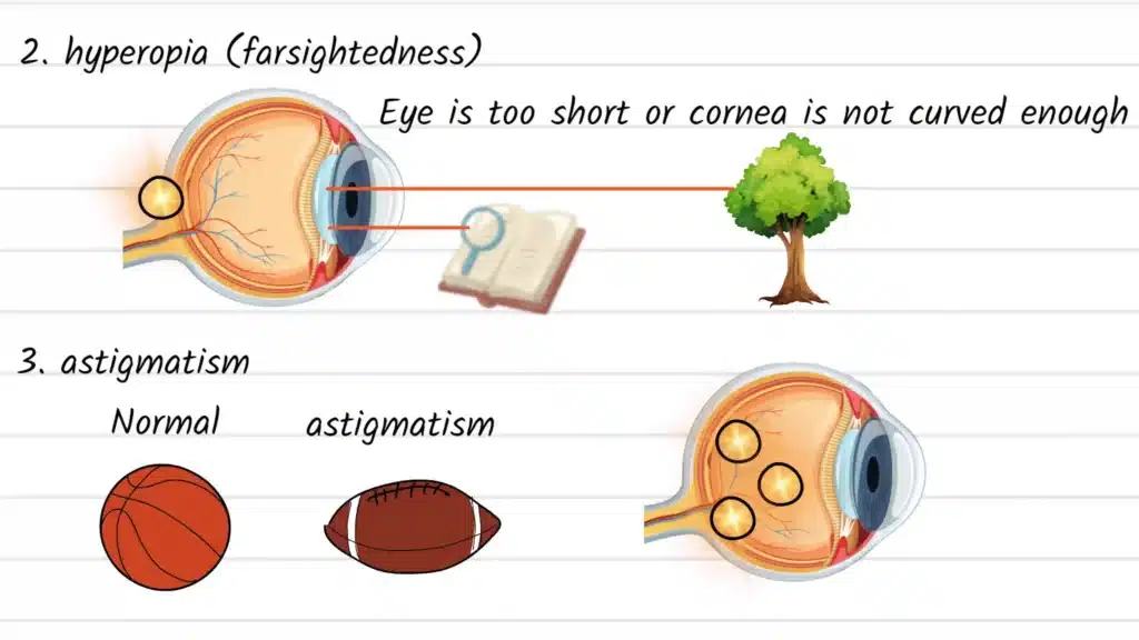 Causes of Blurred Vision hyperopia and astigmatism