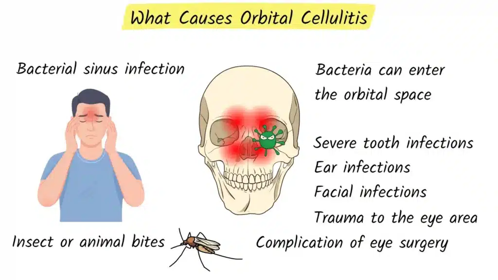 Causes of Orbital Cellulitis