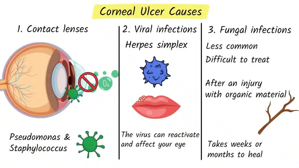 Corneal Ulcer causes