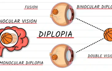 Double Vision (Diplopia) Explained