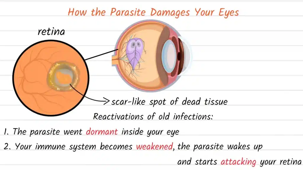 How Ocular Toxoplasmosis damages your eyes