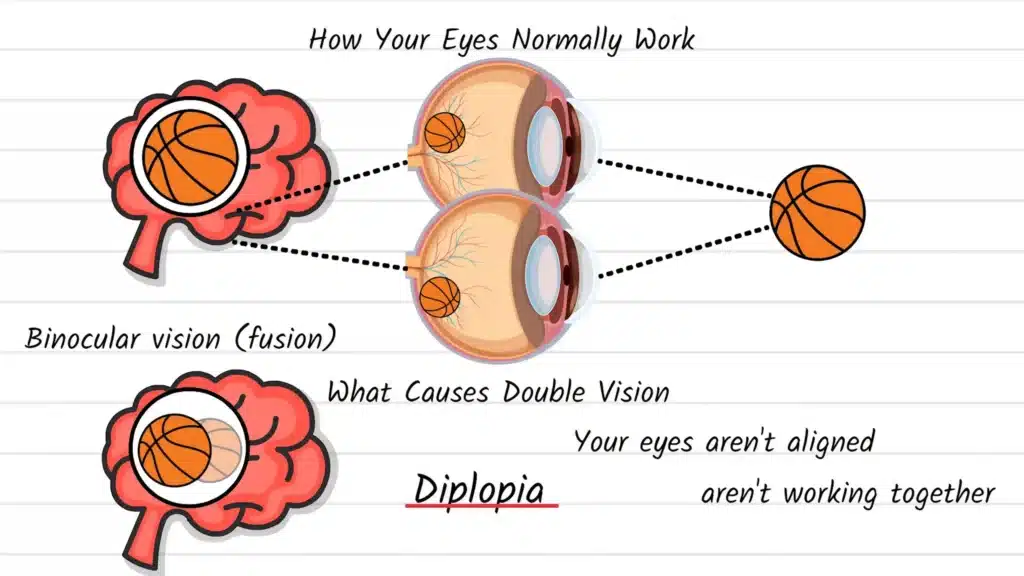 How your eyes normally work and how Diplopia develops