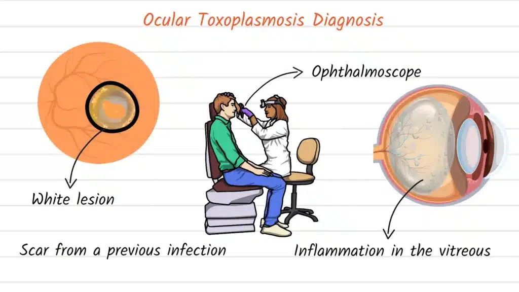 Ocular Toxoplasmosis Diagnosis
