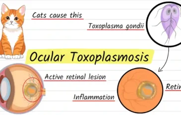 Ocular Toxoplasmosis Explained