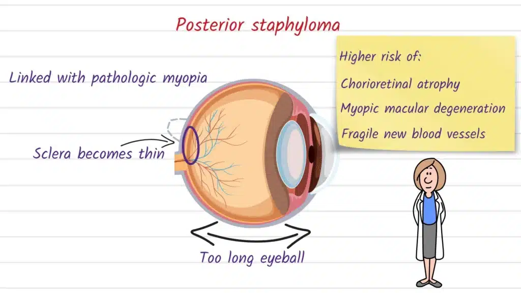 Posterior Staphyloma