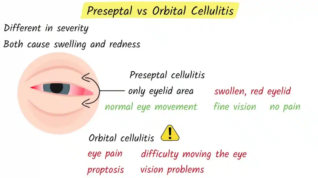 Preseptal vs. Orbital Cellulitis