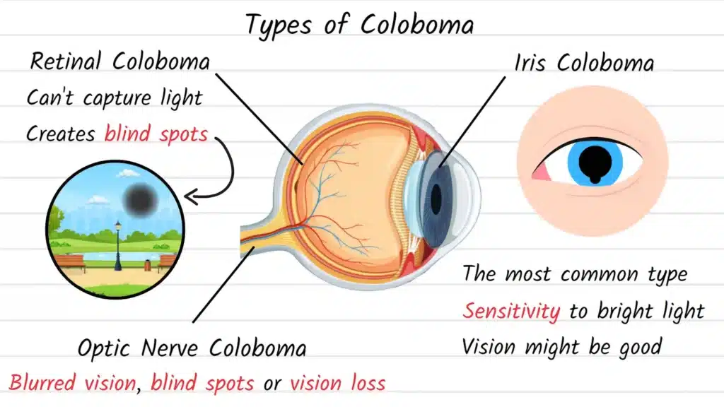 Types of Coloboma