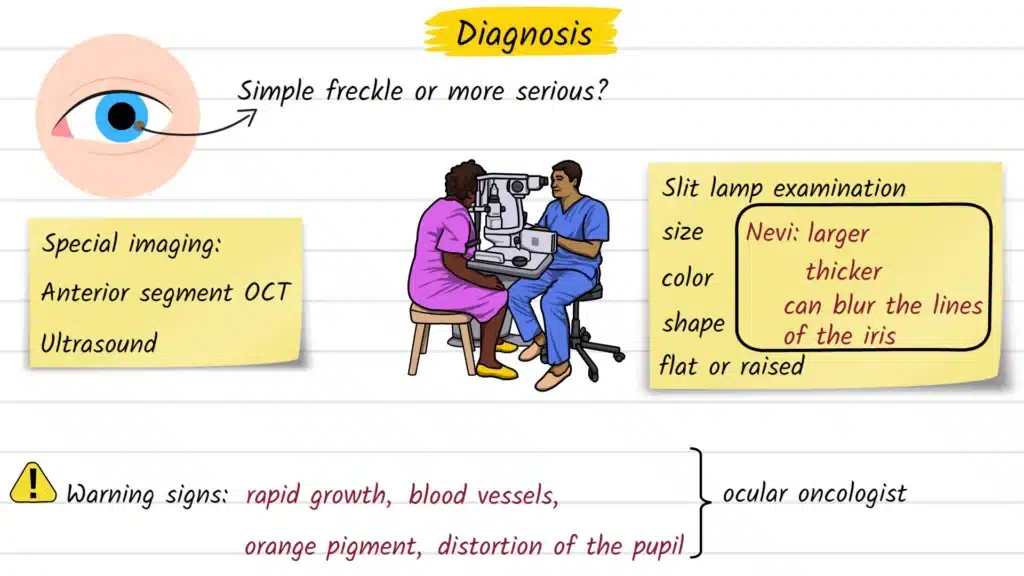 Iris Freckles Diagnosis