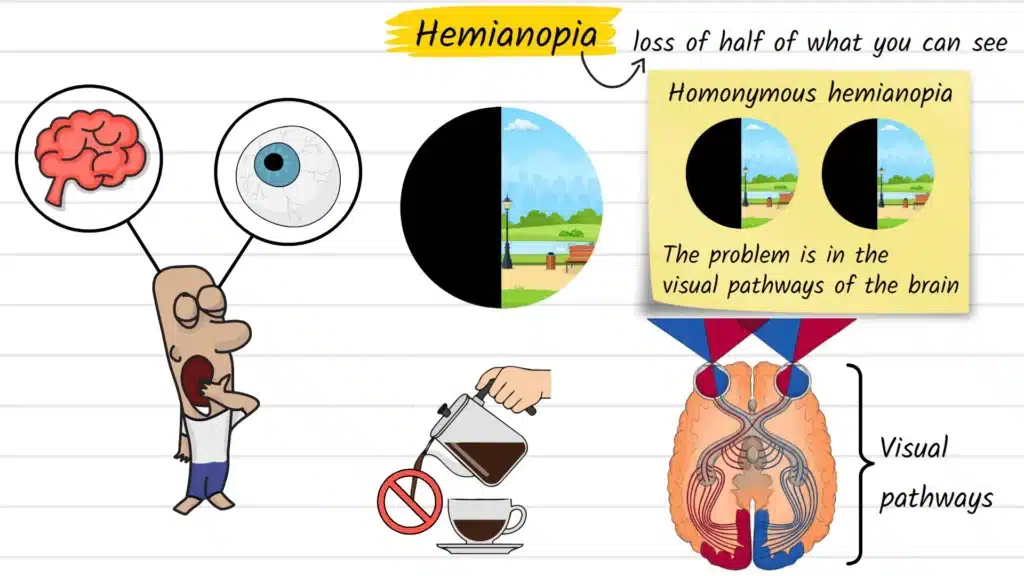 What is Hemianopia