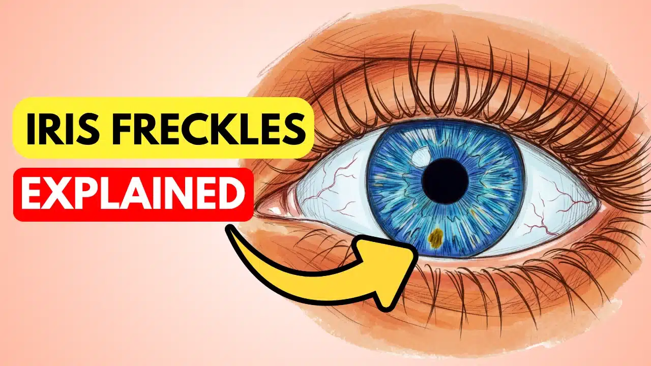 Iris Freckles: Causes, Diagnosis & When to See a Doctor - Eye ...