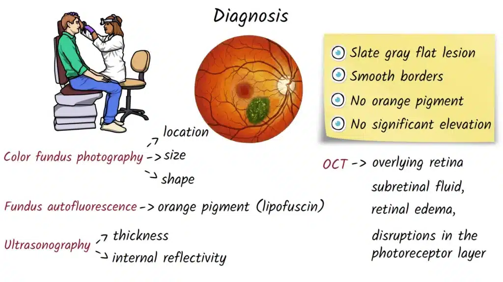 Choroidal Nevus Diagnosis