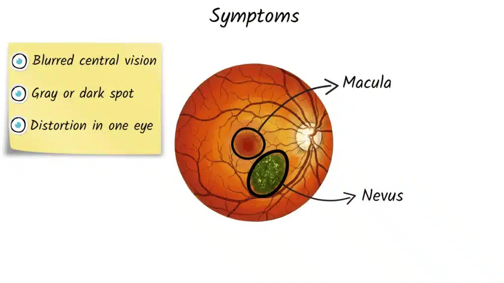 Choroidal Nevus Symptoms