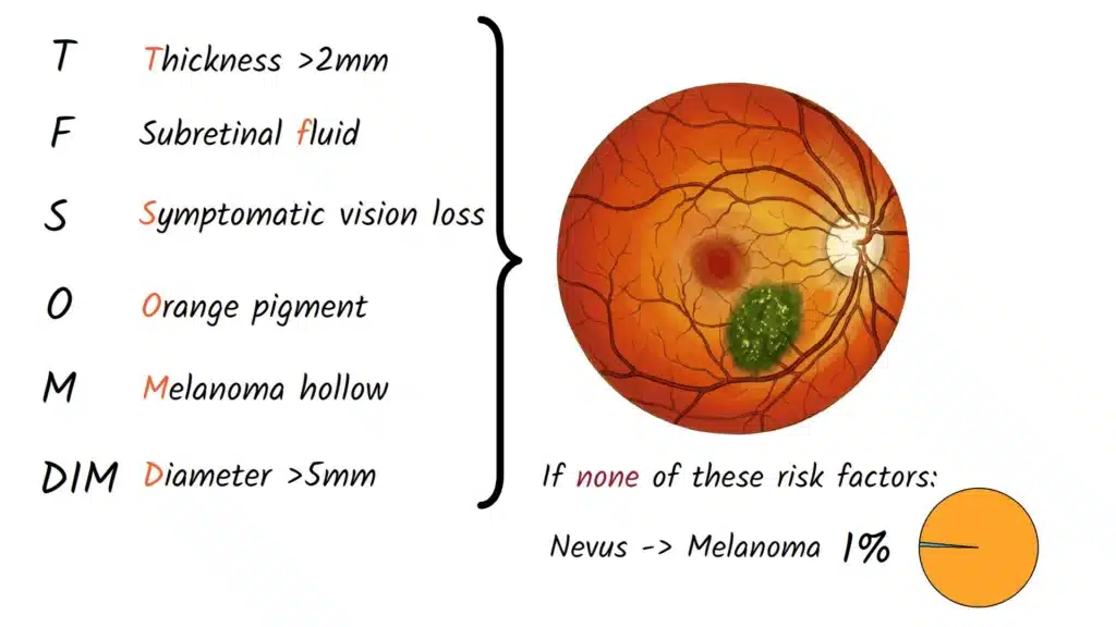 Choroidal Nevus TFSOM DIM