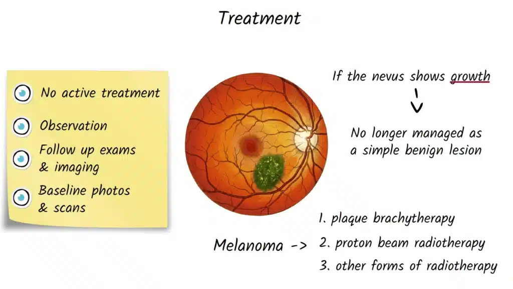Choroidal Nevus Treatment